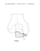 UNICOMPARTMENTAL CUSTOMIZED ARTHROPLASTY CUTTING JIGS diagram and image