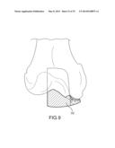 UNICOMPARTMENTAL CUSTOMIZED ARTHROPLASTY CUTTING JIGS diagram and image