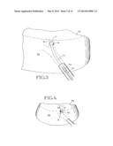 REMOVABLE ANCHORED LUNG VOLUME REDUCTION DEVICES AND METHODS diagram and image