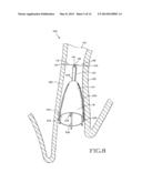 REMOVABLE ANCHORED LUNG VOLUME REDUCTION DEVICES AND METHODS diagram and image