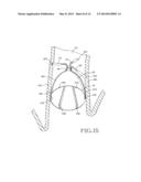 REMOVABLE ANCHORED LUNG VOLUME REDUCTION DEVICES AND METHODS diagram and image