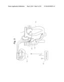 Cardiac Stimulation Apparatus And Method For The Control Of Hypertension diagram and image