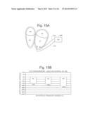 Cardiac Stimulation Apparatus And Method For The Control Of Hypertension diagram and image