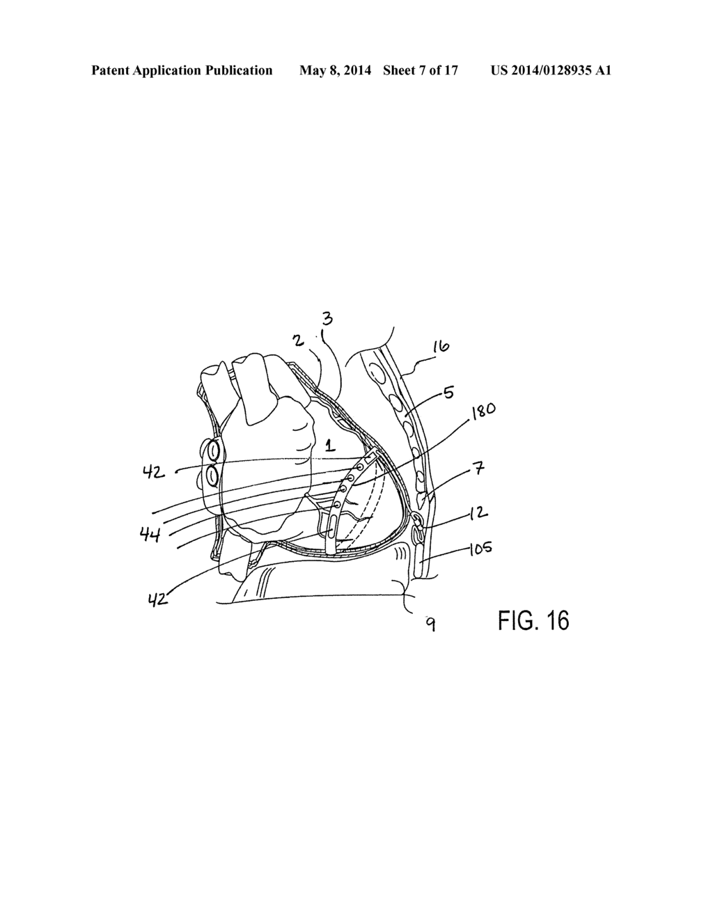 IMPLANTED CARDIAC DEVICE FOR DEFIBRILLATION - diagram, schematic, and image 08