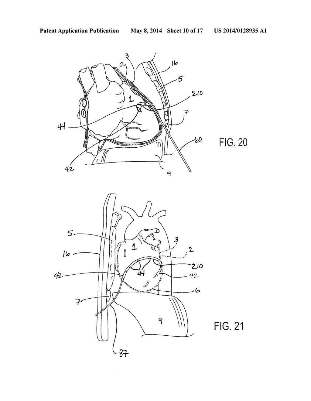 IMPLANTED CARDIAC DEVICE FOR DEFIBRILLATION - diagram, schematic, and image 11