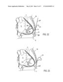IMPLANTED CARDIAC DEVICE FOR DEFIBRILLATION diagram and image