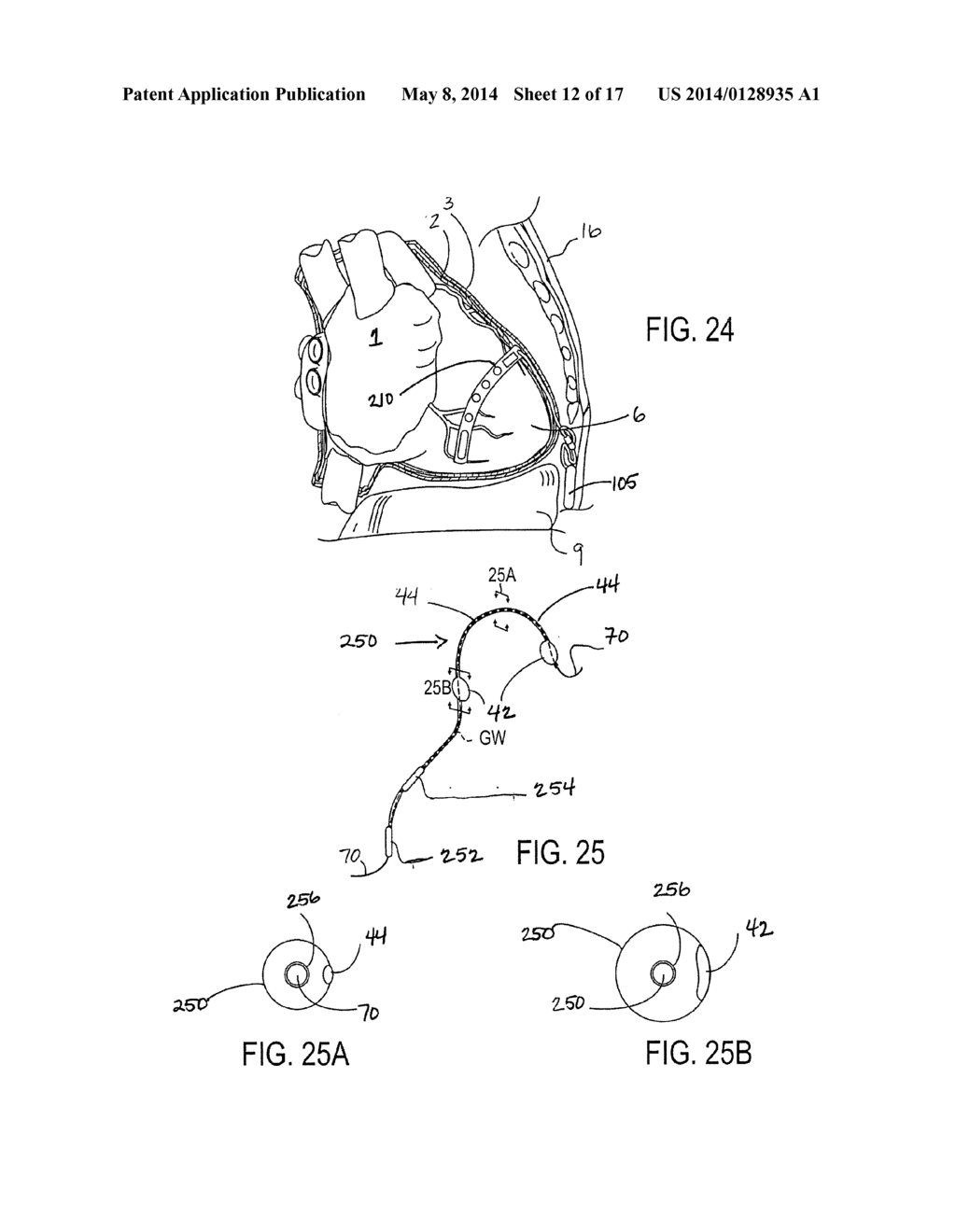 IMPLANTED CARDIAC DEVICE FOR DEFIBRILLATION - diagram, schematic, and image 13