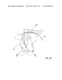 IMPLANTED CARDIAC DEVICE FOR DEFIBRILLATION diagram and image