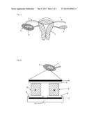 FERTILITY PRESERVATION DEVICE diagram and image