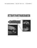 Biodegradable stent with enhanced fracture toughness diagram and image