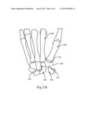 ARTIFICIAL IMPLANT FOR CARPOMETACARPAL JOINT diagram and image