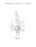 ARTIFICIAL IMPLANT FOR CARPOMETACARPAL JOINT diagram and image