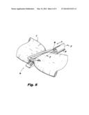 Recessed Groove for Better Suture Retention diagram and image