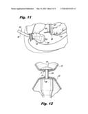 Recessed Groove for Better Suture Retention diagram and image