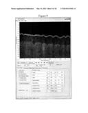 Methods, Systems and Computer Program Products for Processing Images     Generated Using Fourier Domain Optical Coherence Tomography (FDOCT) diagram and image