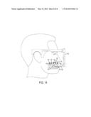 ARCH BARS FOR USE IN MAXILLOFACIAL SURGERY AND ORTHODONTICS diagram and image