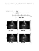 ULTRASOUND DEVICES METHODS AND SYSTEMS diagram and image