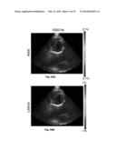 ULTRASOUND DEVICES METHODS AND SYSTEMS diagram and image