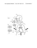 CARDIO-PULMONARY RESUSCITATION AIRWAY VALVE AND DEVICES diagram and image