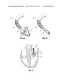 STEERABLE ASSEMBLY FOR SURGICAL CATHETER diagram and image