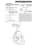 GUIDE CATHETER OCCLUSION BALLOON WITH ACTIVE INFLATION diagram and image