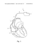 GUIDE CATHETER OCCLUSION BALLOON WITH ACTIVE INFLATION diagram and image