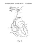 GUIDE CATHETER OCCLUSION BALLOON WITH ACTIVE INFLATION diagram and image