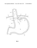 TISSUE FIXATION ASSEMBLY HAVING PREPOSITIONED FASTENERS AND METHOD diagram and image