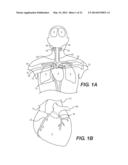 Embolism Deflector diagram and image