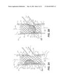 Embolism Deflector diagram and image