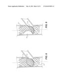 Embolism Deflector diagram and image