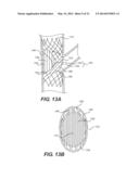 Embolism Deflector diagram and image