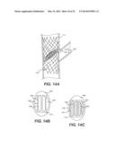 Embolism Deflector diagram and image