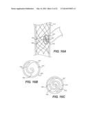 Embolism Deflector diagram and image