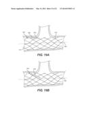 Embolism Deflector diagram and image