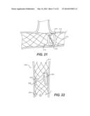 Embolism Deflector diagram and image