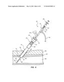 SHEATH AND BALLOON TENSIONER AND LOCATOR SYSTEMS AND METHODS diagram and image