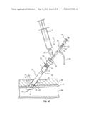 SHEATH AND BALLOON TENSIONER AND LOCATOR SYSTEMS AND METHODS diagram and image