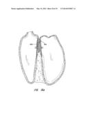 MULTI-LAYER BRAIDED STRUCTURES FOR OCCLUDING VASCULAR DEFECTS diagram and image