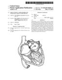 PERCUTANEOUS CATHETER DIRECTED INTRAVASCULAR OCCLUSION DEVICE diagram and image