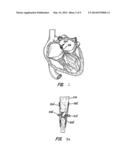 PERCUTANEOUS CATHETER DIRECTED INTRAVASCULAR OCCLUSION DEVICE diagram and image