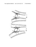 PERCUTANEOUS CATHETER DIRECTED INTRAVASCULAR OCCLUSION DEVICE diagram and image