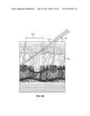 METHODS AND DEVICES FOR TREATING TISSUE diagram and image