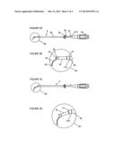 TRANSFORAMINAL INTERSOMATIC CAGE FOR AN INTERVERTEBRAL FUSION GRAFT AND AN     INSTRUMENT FOR IMPLANTING THE CAGE diagram and image