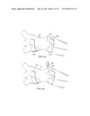 PRONE AND LATERALLY ANGLED SURGICAL DEVICE AND METHOD diagram and image