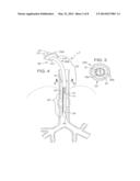 SECRETION CLEARING PATIENT AIRWAY MANAGEMENT SYSTEM diagram and image