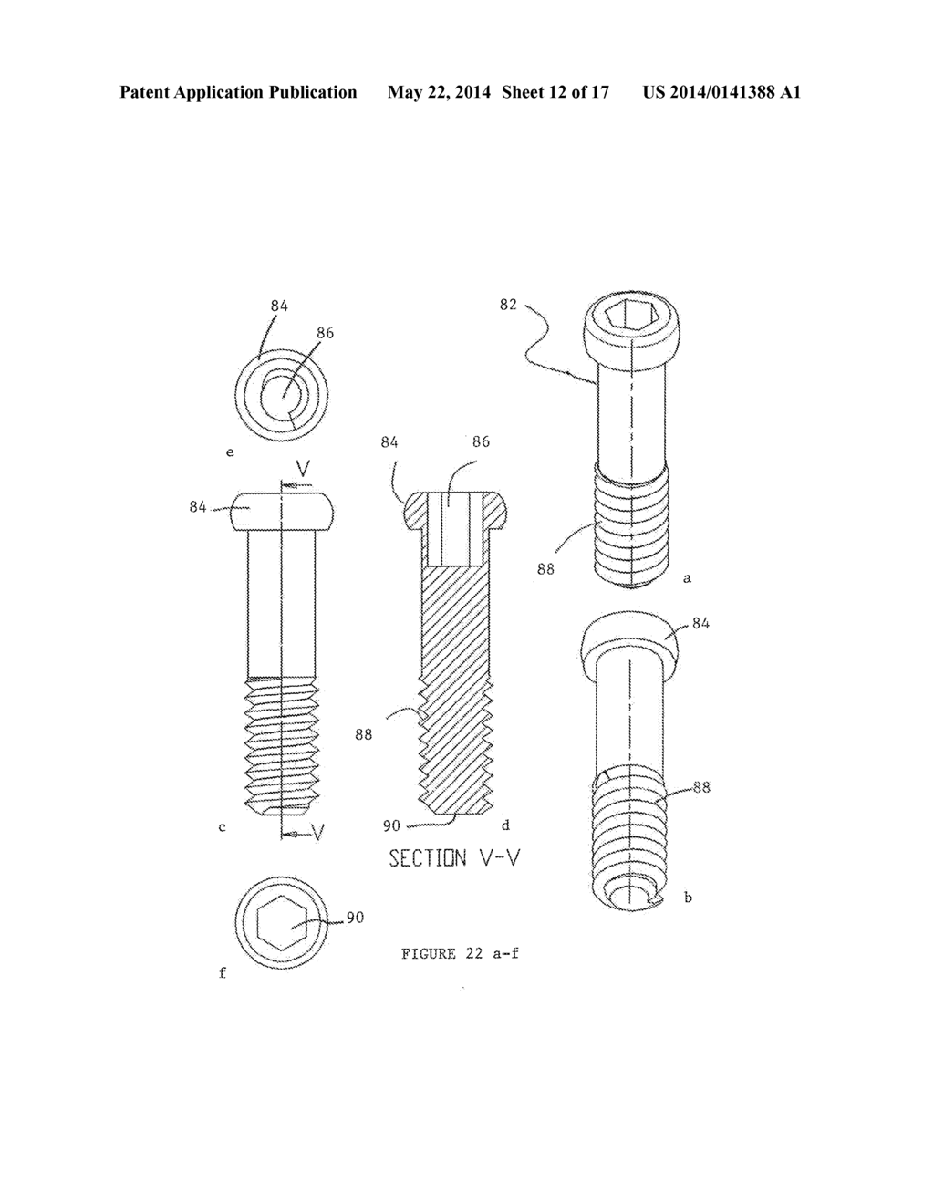 Dental Implant and Method of Implantation - diagram, schematic, and image 13