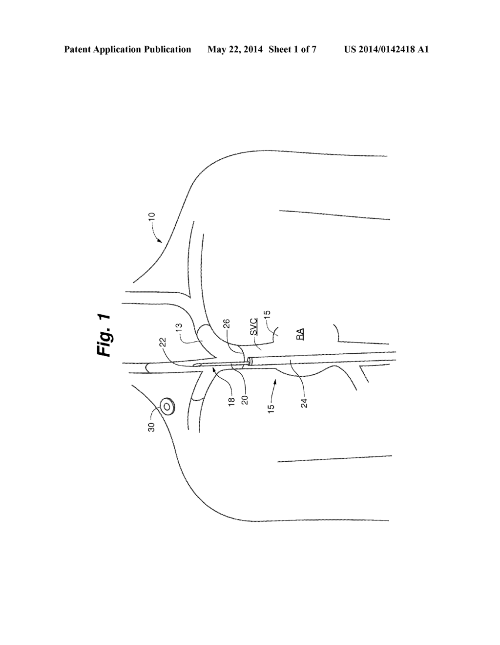 OCCLUSION ACCESS SYSTEM - diagram, schematic, and image 02