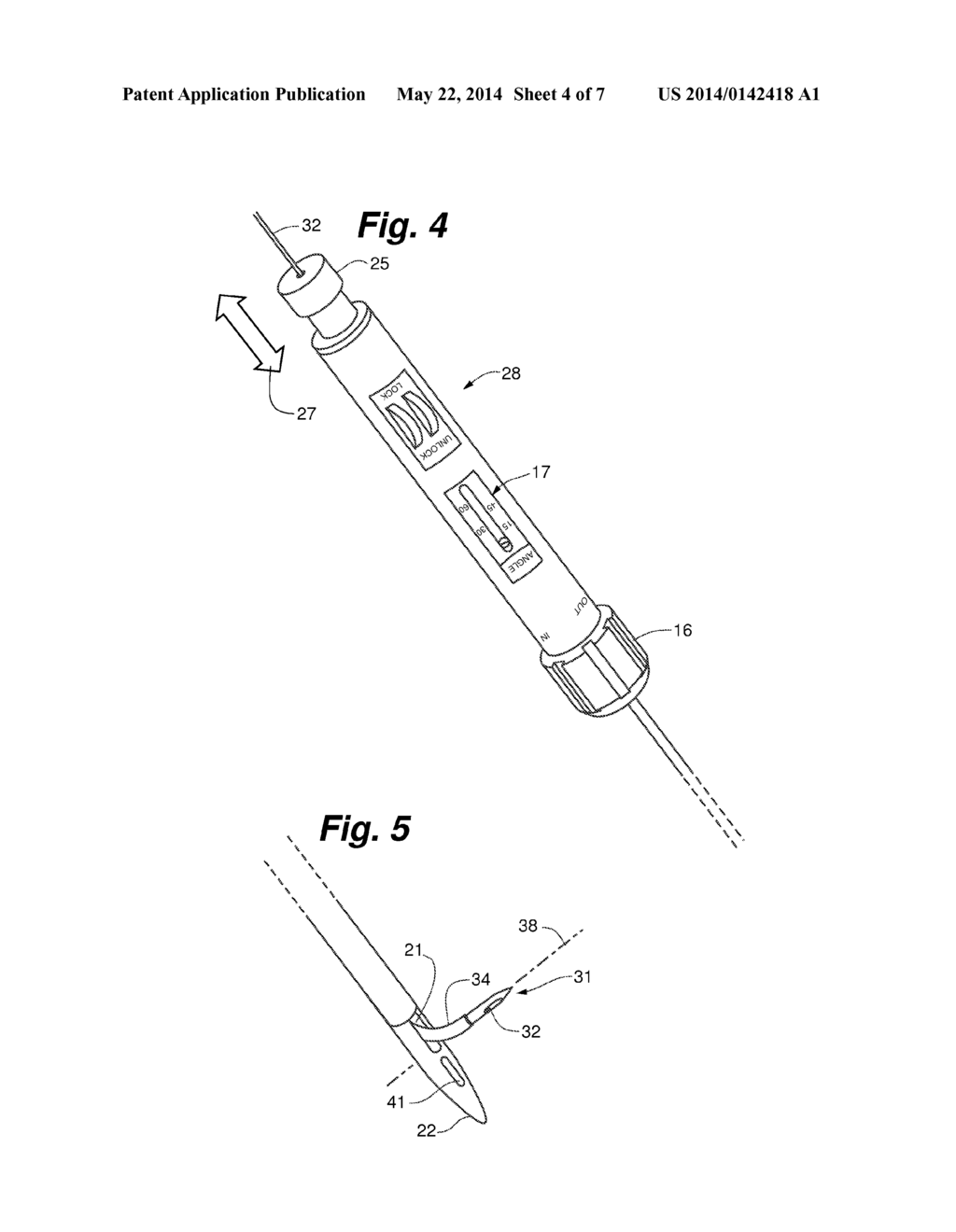 OCCLUSION ACCESS SYSTEM - diagram, schematic, and image 05