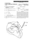 Minimally Invasive Method for Coronary Bypass and Other Treatments diagram and image